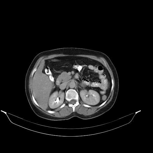 File:Calcified hydatid cyst of the liver (Radiopaedia 21212-21112 Axial C+ delayed 20).jpg