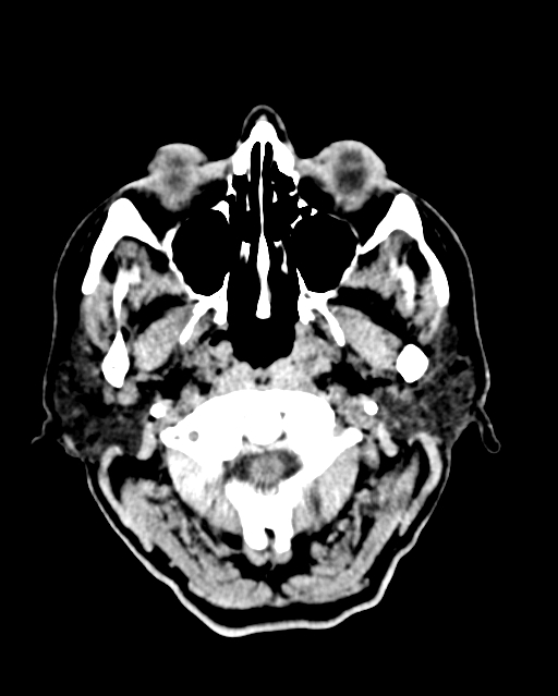 Calcified meningioma (Radiopaedia 74361-85243 Axial non-contrast 51).jpg