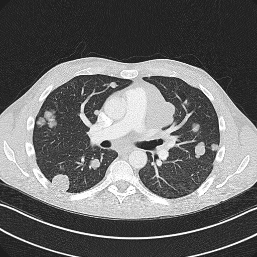Cannonball metastases - testicular choriocarcinoma (Radiopaedia 84510-99891 Axial lung window 47).jpg