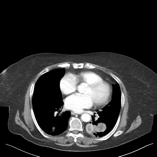 Cannonball metastases from endometrial cancer (Radiopaedia 42003-45031 E 3).png