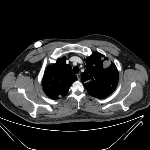 File:Cannonball pulmonary metastases (Radiopaedia 67684-77101 D 59).jpg