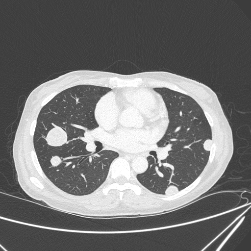 Canonball lung metastasis (Radiopaedia 77634-89837 Axial lung window 93).jpg