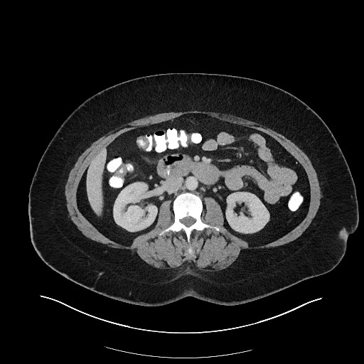 Carcinoid tumor - terminal ileum (Radiopaedia 60931-68739 A 61).jpg