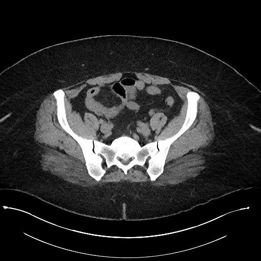 File:Carcinoid tumor - terminal ileum (Radiopaedia 60931-68740 Axial non-contrast 90).jpg