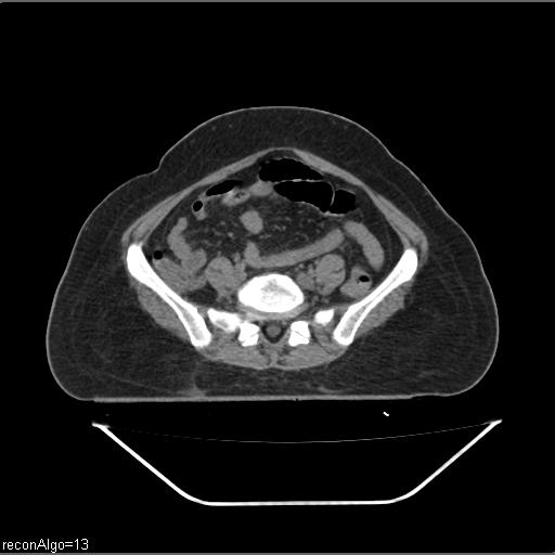 Carcinoma cervix- brachytherapy applicator (Radiopaedia 33135-34173 Axial non-contrast 3).jpg