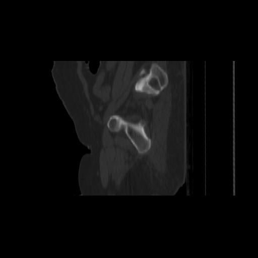Carcinoma cervix- brachytherapy applicator (Radiopaedia 33135-34173 Sagittal bone window 152).jpg