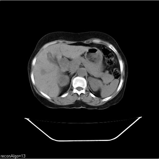 File:Carcinoma cervix- recurrence (Radiopaedia 34702-36137 Axial non-contrast 13).jpg