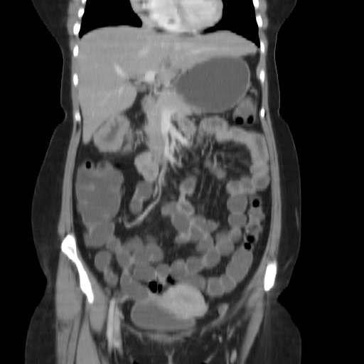 File:Carcinoma colon - hepatic flexure (Radiopaedia 19461-19493 B 15).jpg
