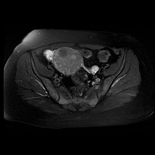 File:Carcinoma of the cervix (Radiopaedia 89018-105858 Axial T2 fat sat 5).jpg