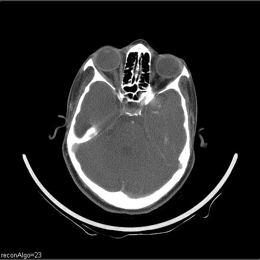 File:Carcinoma of the maxillary antrum (Radiopaedia 53805-59888 Axial C+ delayed 67).jpg