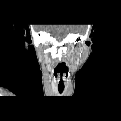 Carcinoma of the maxillary antrum (Radiopaedia 53805-59888 Coronal C+ delayed 98).jpg