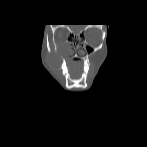 Carcinoma of the maxillary antrum (Radiopaedia 53805-59888 Coronal bone window 31).jpg