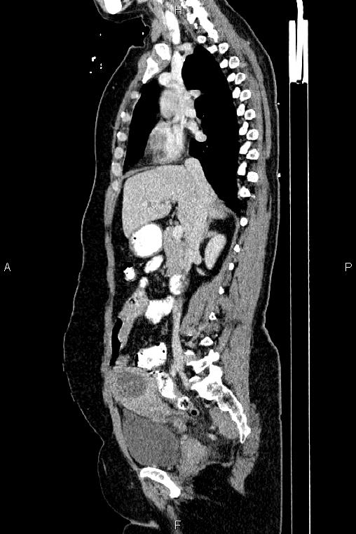 Carcinoma of uterine cervix (Radiopaedia 85861-101700 D 33).jpg