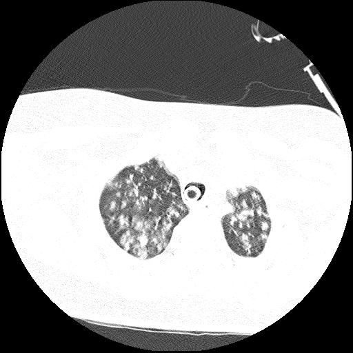 Cardiac angiosarcoma (Radiopaedia 66010-75181 Axial lung window 80).jpg