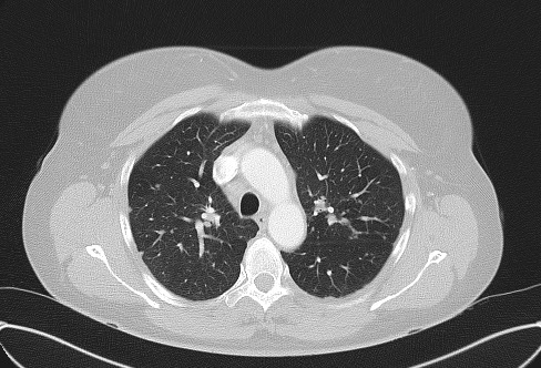 Cardiac sarcoidosis (Radiopaedia 74548-85534 Axial lung window 25).jpg