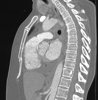 Cardiac sarcoidosis (Radiopaedia 74548-85534 Sagittal lung window 44).jpg