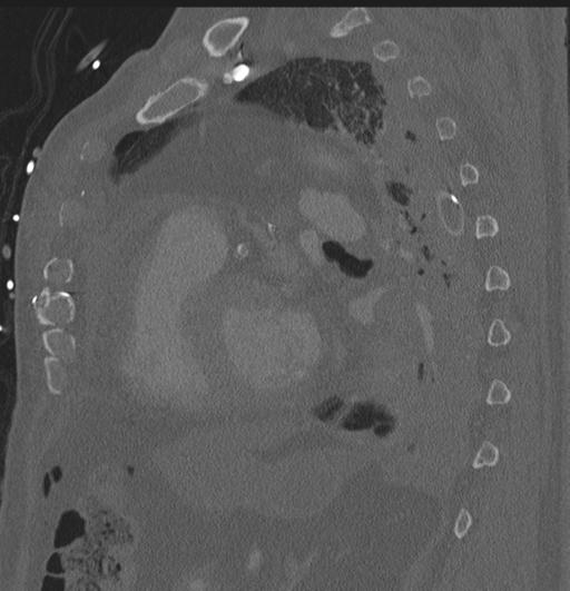 Cardiac trauma (Radiopaedia 32874-33858 Sagittal bone window 11).jpg