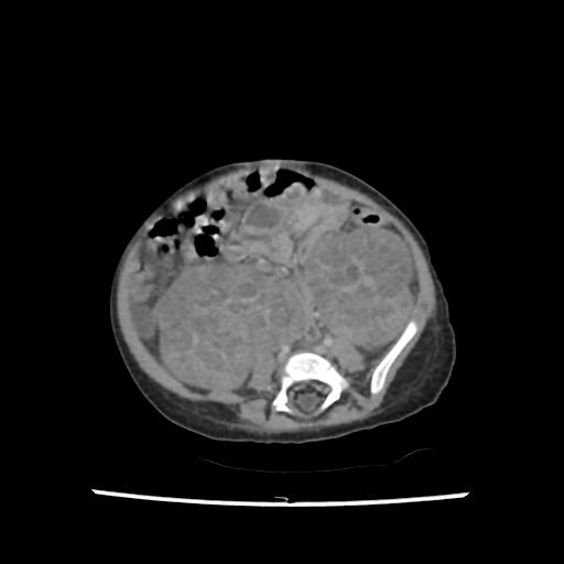 Caroli disease with autosomal recessive polycystic kidney disease (ARPKD) (Radiopaedia 89651-106703 B 154).jpg