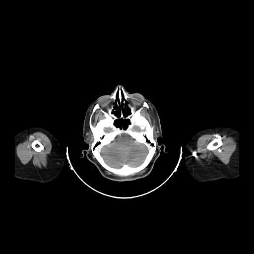 File:Carotid body tumor (Radiopaedia 21021-20948 B 1).jpg