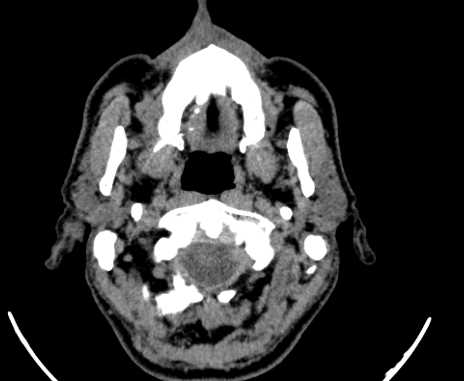 Carotid body tumor (Radiopaedia 61750-69757 Axial non-contrast 8).jpg