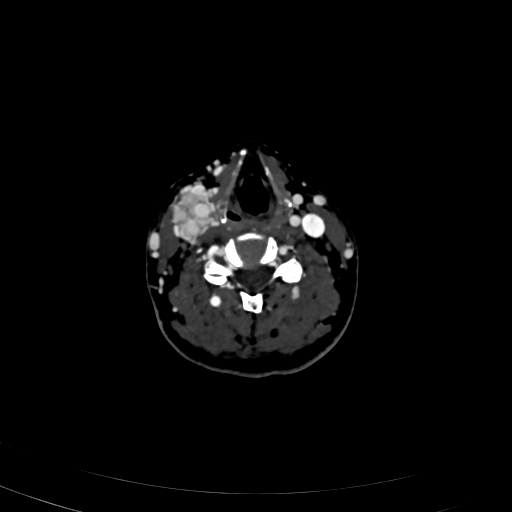 Carotid body tumor (Radiopaedia 83615-98727 D 72).jpg