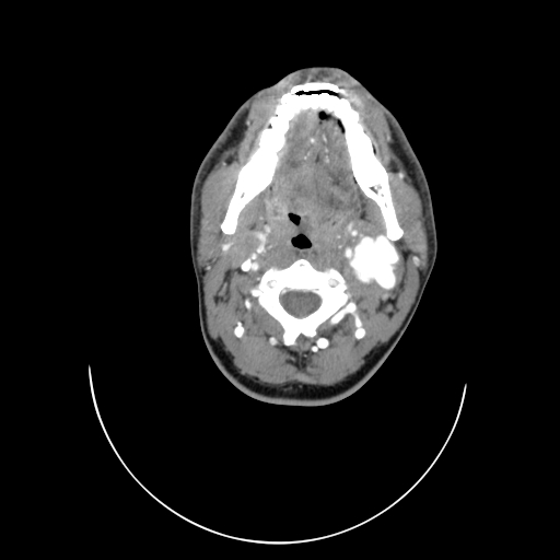 Carotid bulb pseudoaneurysm (Radiopaedia 57670-64616 A 21).jpg