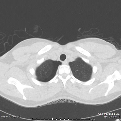 Catamenial pneumothorax (Radiopaedia 54382-60600 Axial non-contrast 11).jpg