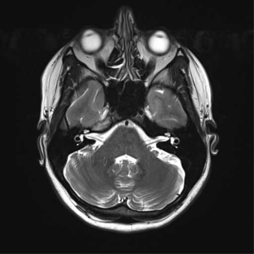 File:Cavernoma with bleed - midbrain (Radiopaedia 54546-60773 Axial T2 10).png
