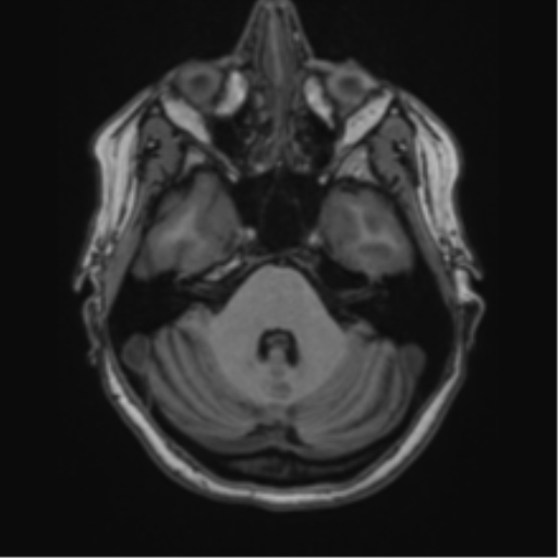 Cavernoma with bleed - midbrain (Radiopaedia 54546-60774 Axial T1 3).png