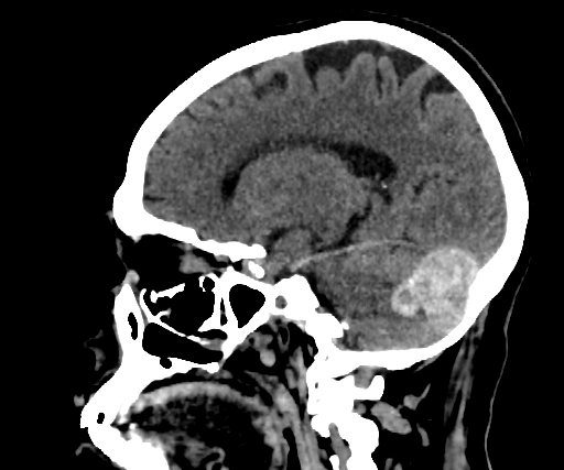 Cavernous hemangioma of the cerebellar falx (Radiopaedia 73025-83723 B 129).jpg