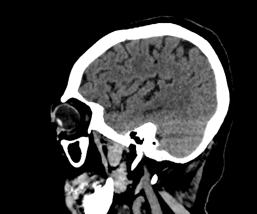 Cavernous hemangioma of the cerebellar falx (Radiopaedia 73025-83723 B 83).jpg