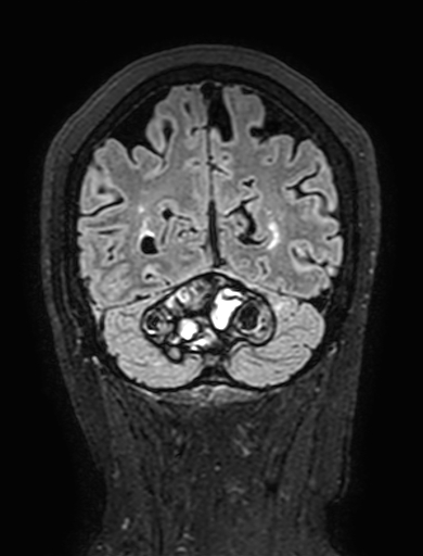Cavernous hemangioma of the cerebellar falx (Radiopaedia 73025-83724 Coronal FLAIR 281).jpg
