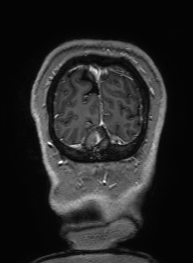 Cavernous hemangioma of the cerebellar falx (Radiopaedia 73025-83724 Coronal T1 C+ 348).jpg