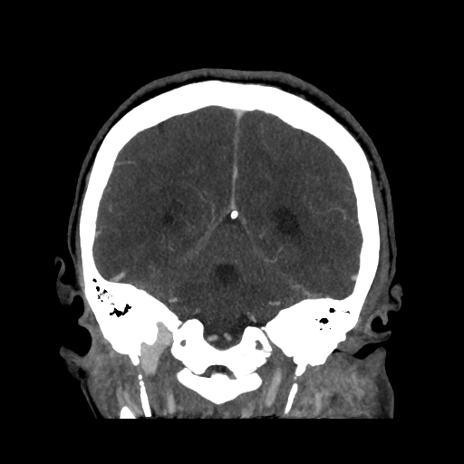 File:Cavernous sinus thrombosis (Radiopaedia 10619-11078 D 22).jpg