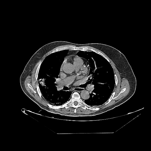 Cavitating bronchogenic carcinoma (Radiopaedia 44489-48162 Axial non-contrast 41).jpg