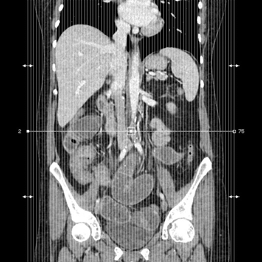 Cecal adenocarcinoma (Radiopaedia 75909-87331 C 1).jpg
