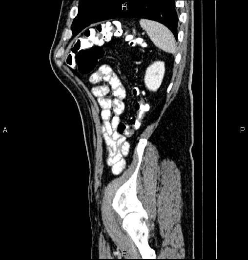 Cecal adenocarcinoma (Radiopaedia 85324-100916 E 78).jpg