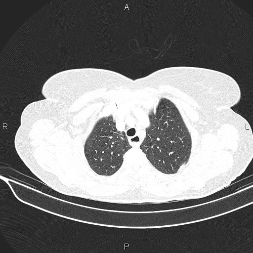 Cecal cancer (Radiopaedia 85610-101358 Axial lung window 14).jpg