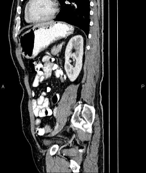 File:Cecal cancer with appendiceal mucocele (Radiopaedia 91080-108651 E 66).jpg