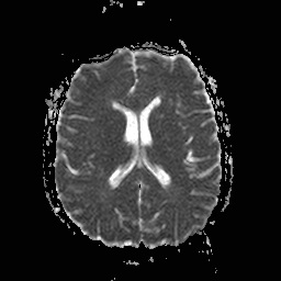 File:Central-variant posterior reversible encephalopathy syndrome (PRES) (Radiopaedia 43880-47358 Axial ADC 13).jpg