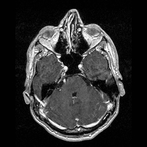 File:Central-variant posterior reversible encephalopathy syndrome (PRES) (Radiopaedia 43880-47358 Axial T1 C+ 38).jpg