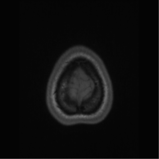 File:Central neurocytoma (Radiopaedia 37664-39557 Axial T1 70).png