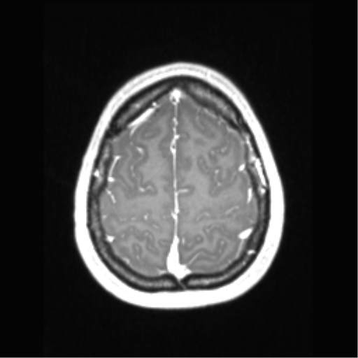 File:Central neurocytoma (Radiopaedia 37664-39557 Axial T1 C+ 67).png