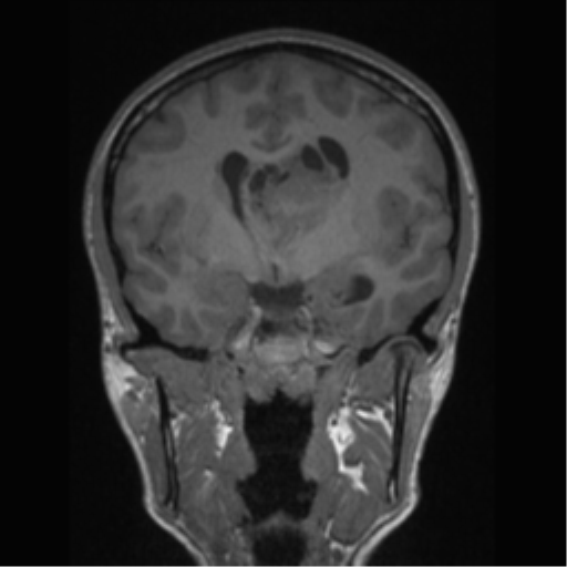 Central neurocytoma (Radiopaedia 37664-39557 Coronal T1 50).png