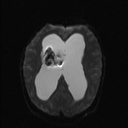 Central neurocytoma (Radiopaedia 56690-63469 Axial DWI 12).jpg