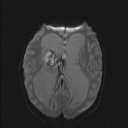 Central neurocytoma (Radiopaedia 56690-63469 Axial DWI 30).jpg