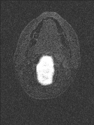 Central neurocytoma (Radiopaedia 56690-63469 Axial T1 C+ 165).jpg
