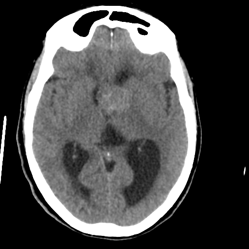 Central neurocytoma (Radiopaedia 65317-74346 Axial non-contrast 24).png