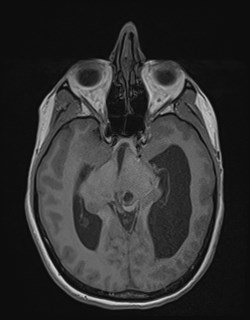 Central neurocytoma (Radiopaedia 84497-99872 Axial T1 85).jpg