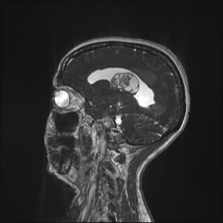 Central neurocytoma (Radiopaedia 84497-99872 Sagittal CISS 16).jpg